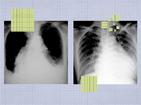 Heart failure: How does it appear on a chest X-ray?