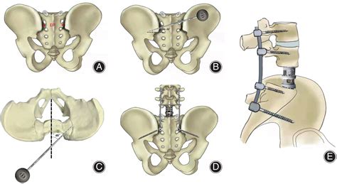 Freehand S2‐Alar‐Iliac Screw Placement Technique in Lumbosacral Spinal Tumors: A Preliminary ...