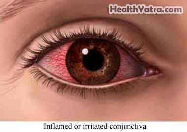 Keratoconjunctivitis Sicca Definition, Causes, Symptoms, Complications and Cost Surgery ...