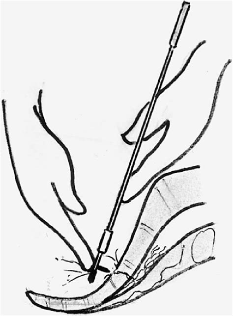 Figure 1 from Management of Presacral Venous Bleeding with the Use of ...