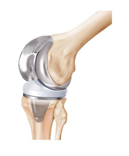 Study reveals simultaneous bilateral total knee arthroplasty has increased risk of complications ...