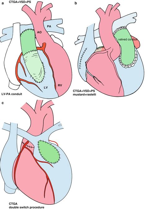 Corrected Transposition of the Great Arteries | Thoracic Key