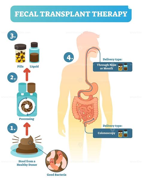 Fecal transplant therapy, procedure steps diagram, vector illustration - VectorMine