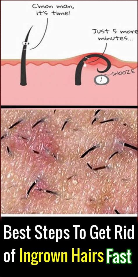 Best Steps To Get Rid of Ingrown Hairs Fast – Face Errors #ingrownhairs #hair #ingrown | Ingrown ...