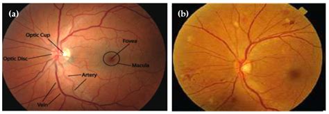 Diagnostics | Free Full-Text | Mobile-HR: An Ophthalmologic-Based Classification System for ...