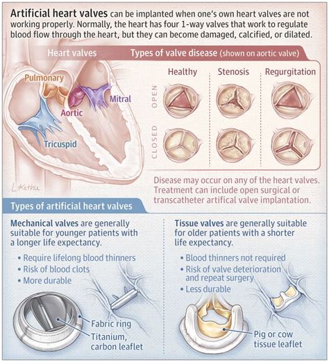 Artificial Heart Valves