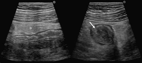 Mesenteric fat edema (asterisk) and terminal ileum wall thickening ...