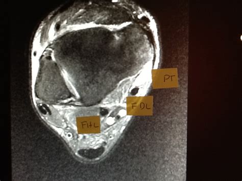 Foot and Ankle Problems By Dr. Richard Blake: Posterior Tibial Tendon Tear: MRI images