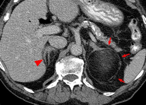 Imaging of the Adrenal Gland Lesions