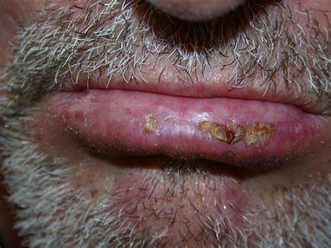 Actinic Cheilitis: Pictures, Lip Changes, and Treatment