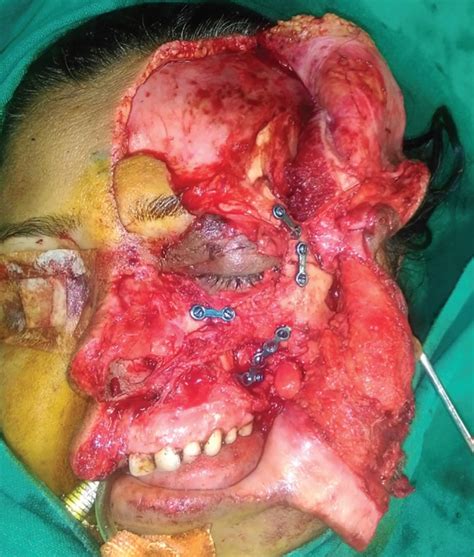 Primary One Stage Reconstruction in Complex Facial Avulsion Injury. - Abstract - Europe PMC