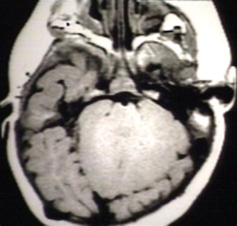 Arnold-Chiari malformation MRI - wikidoc