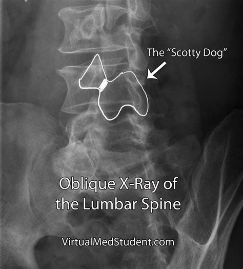 VirtualMedStudent.com || Spondylolysis