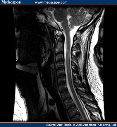 Multiple Sclerosis (MS) of the Spinal Cord