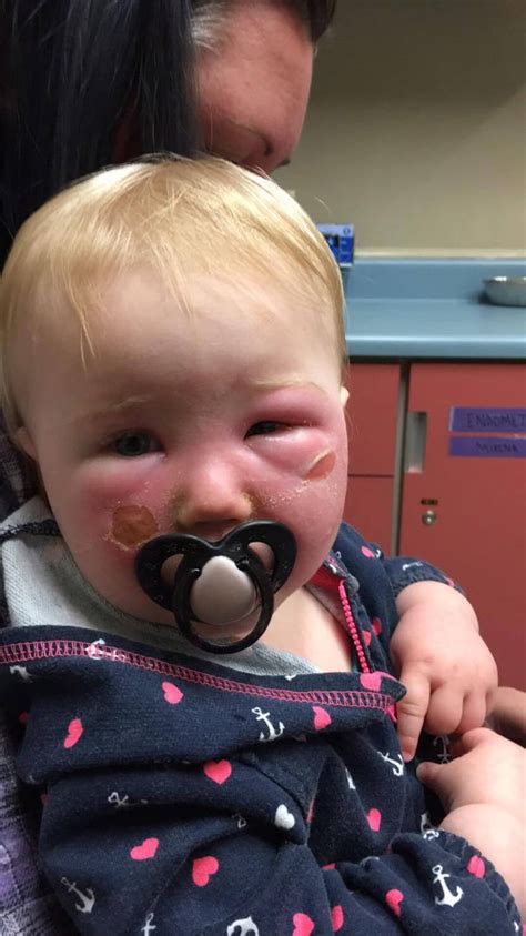 Mom warns about sunscreen after toddler ends up in ER with bad reaction