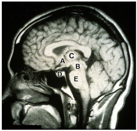 Brain MRI side view Diagram | Quizlet