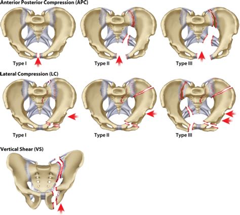 Pelvic Fractures - Physiopedia