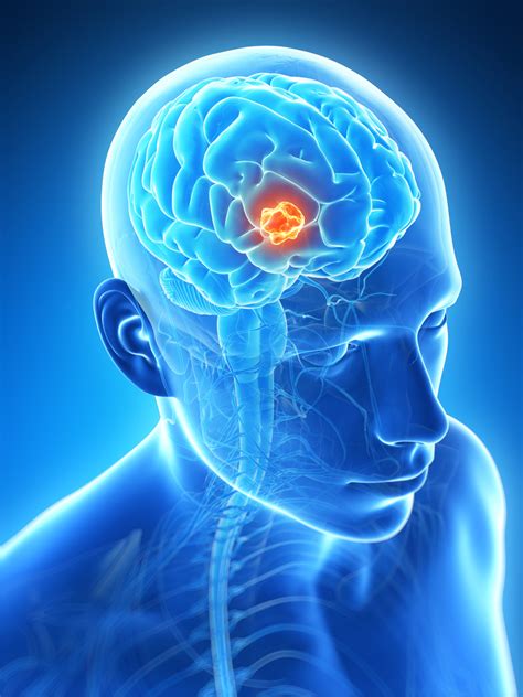 Understanding The Craniotomy Procedure - Rocky Mountain Brain and Spine ...