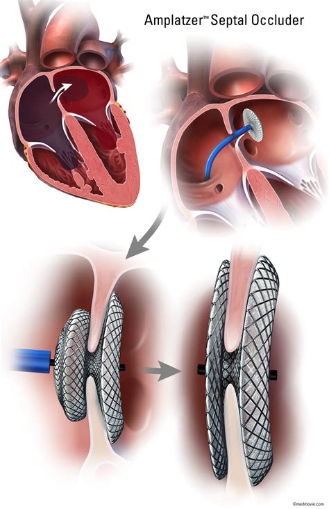 Medmovie.com | Amplatzer Septal Occluder