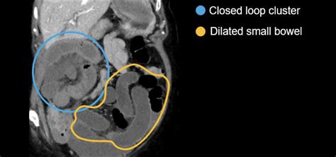 Abdominal CT: closed loop • LITFL • Radiology Library