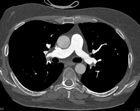 Extensive Pulmonary Embolism - Chest Case Studies - CTisus CT Scanning