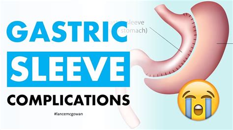 Top 5 Gastric Sleeve Complications You Should Know About - YouTube