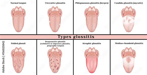 Types glossitis: candidiasis (mycotic), ulcerative, abscess (herpes), desquamative (exfoliative ...