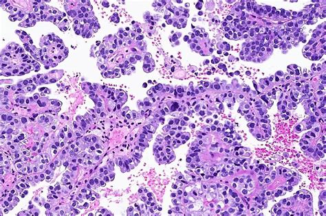 Clear cell carcinoma (uterus) - MyPathologyReport.ca