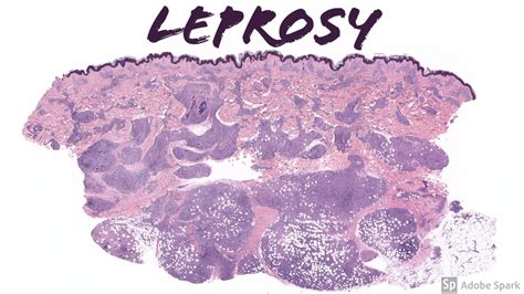 Lepromatous Leprosy (Hansen Disease): 5-Minute Pathology Pearls - YouTube