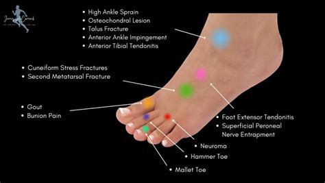 Anterior Aspect Of Foot Pain