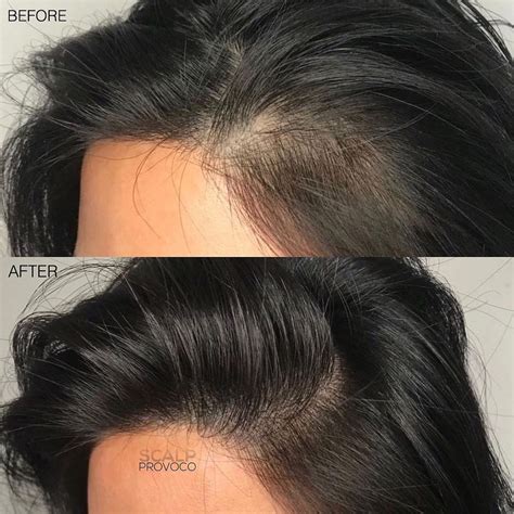 Top 48 image hair thinning in women - Thptnganamst.edu.vn