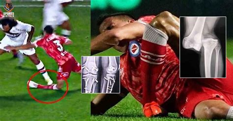 Luciano Sanchez Knee Injury | Sanchez Knee Injury X-rays | Sanchez Knee X-Ray