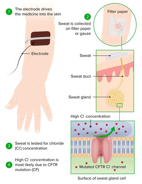 Cystic Fibrosis | Concise Medical Knowledge