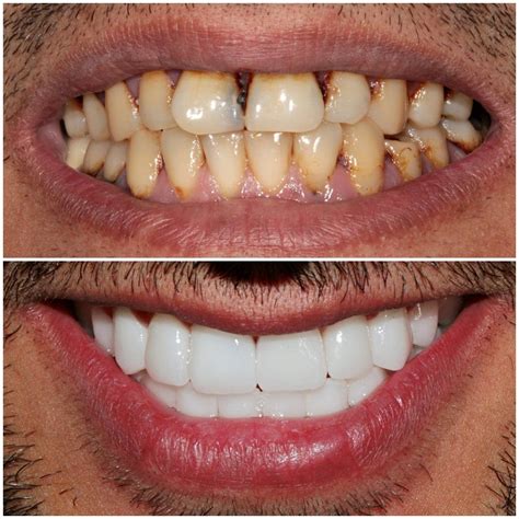 Smile Makeover Turkey | Dental crowns, Dental veneers, Dental