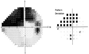 Glaucoma Vision Loss Pattern