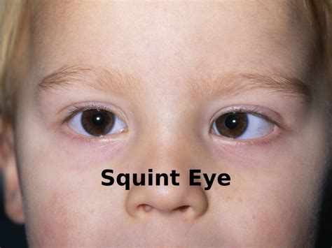 Squint Surgery in Andheri West, Mumbai - Dr Vaidya Eye Hospital