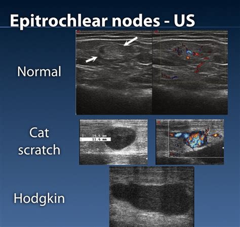 Epitrochlear Nodes