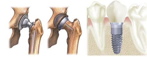 The SuperBones; Smart Coating Gel for Titanium Implants