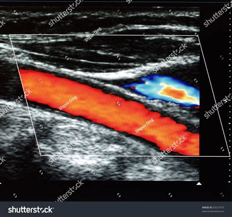 Color Doppler Flow Imaging Of Human Carotid Artery Stock Photo 63527575 : Shutterstock