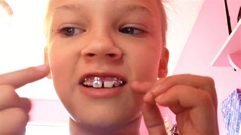 Orthodontists warn against homemade braces | CTV News