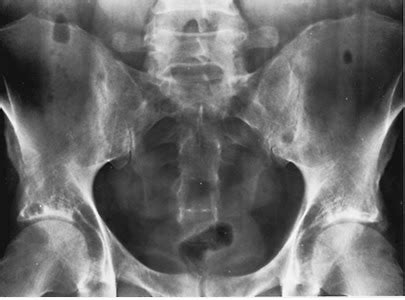 ON - RADIOLOGY: Psoriatic arthritis in the sacroiliac joint