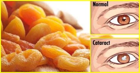 10 Effective Home Remedies For Cataracts