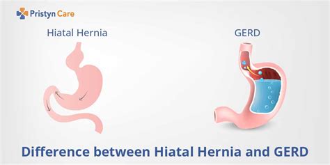 Difference between Hiatal Hernia and GERD | Hiatal Hernia Vs GERD