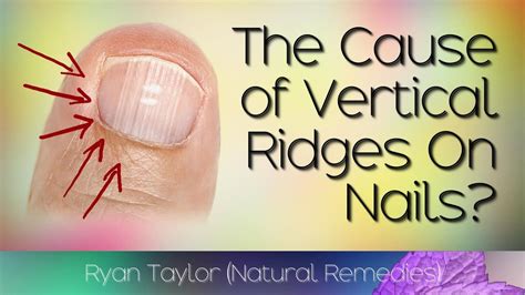 Do You Have Vertical Ridges On Your Nails? (Cause) - YouTube in 2021 | Fingernail health signs ...