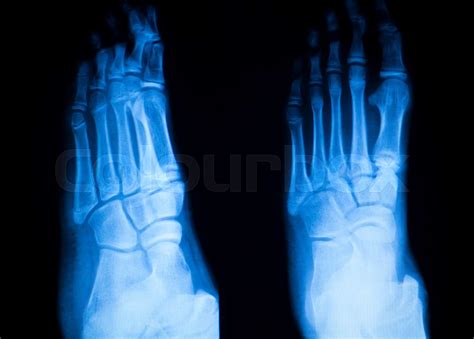 Foot and toes injury x-ray scan | Stock image | Colourbox