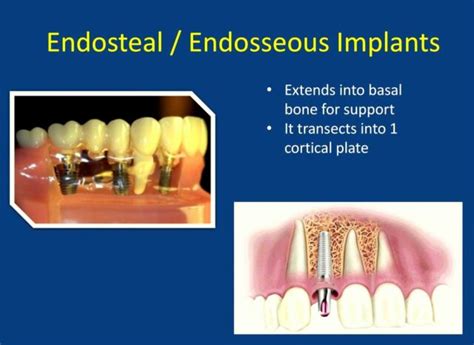 Types of Dental Implants | Quality Dental Care | Adelaide, South Australia