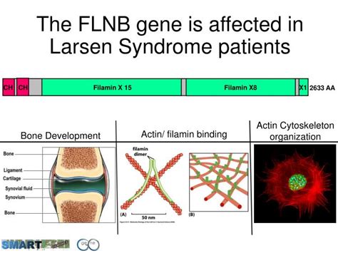 PPT - Larsen Syndrome PowerPoint Presentation - ID:2383102