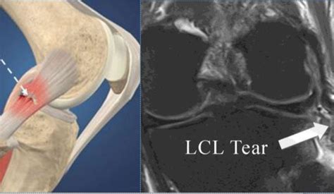 LCL Reconstruction Surgery in Chennai | LCL Reconstruction Specialist in Chennai