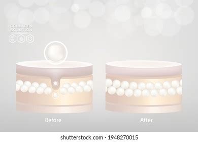 Hyaluronic Acid Before After Skin Solutions Stock Vector (Royalty Free) 1954083442 | Shutterstock