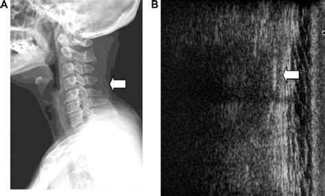 Posterior Longitudinal Ligament Calcification Mri